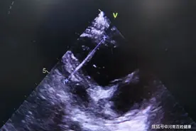 揪心！1岁宝宝，被4厘米钢针刺穿心脏图片