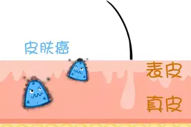 皮肤癌：你能认出“百变”的我吗？图片