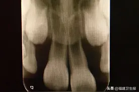 坑！福州7岁女孩牙缝变大，村口牙医竟用橡皮筋绑！10天后2颗门牙差点没了图片