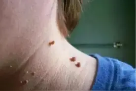 脖子和腋下的“小肉粒”是什么？图片