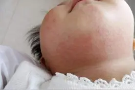 新生儿的皮肤护理指南，这七大常见的皮肤问题处理方法，可要收好图片