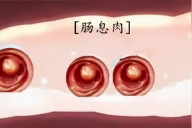肠息肉切除后，多长时间复查比较合适？会复发吗？图片