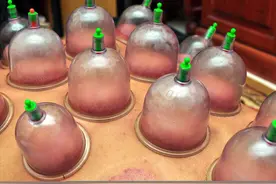 拔罐后的皮肤变紫黑色，代表着什么问题？中医给出2个解释图片