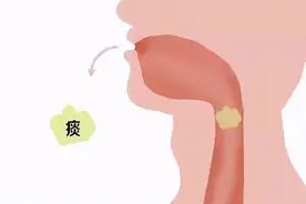吐出的痰液颜色不同说明了什么？黑痰、黄痰、白痰，哪个更严重？图片