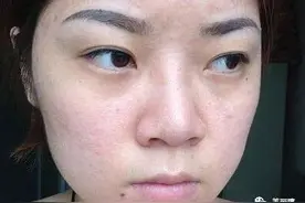 为什么经常敷面膜的女人皮肤最差？医生提醒：不想烂脸赶快戒掉图片