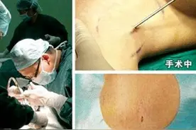 你知道吗？手术治疗腋臭会有副作用吗？图片