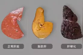 提醒：肝不好的人，这几种水果可以多吃点，或能帮助修复肝功能图片