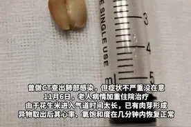 健康丨67岁老人咳嗽9年不愈只因一粒花生米图片