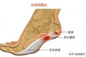 足底筋膜炎练瑜伽能缓解？简单的瑜伽练习预防和改善方法都在这图片