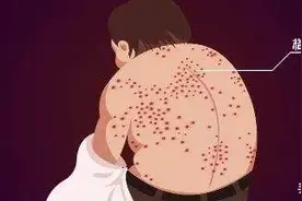 梅毒到底能不能治愈？看医生怎么说！图片