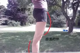 大腿前面粗，小腿后边粗？快来看看是不是膝超伸了图片