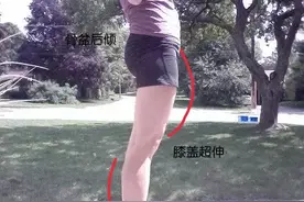大腿前面粗，小腿后边粗？快来看看是不是膝超伸了图片