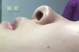 鼻翼缘退缩矫正后气质改变能有多大？图片