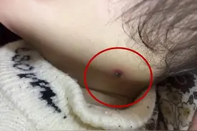 女儿身上多出“一颗痣”，父母看后送去检查，医生：还好发现及时图片