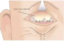 如果眼部整形做得不满意还可以修复吗？眼窝凹陷怎么办？图片