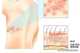 带状疱疹发作，制服“缠腰龙”，龙头龙尾是关键。图片