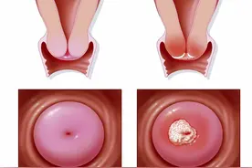宫颈癌疫苗有必要打么？图片
