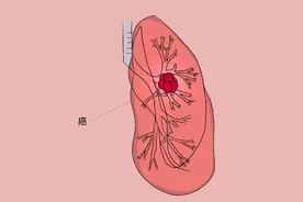 原位癌被踢出肺癌家族，不在重疾险里了，那还需要手术切除吗？图片