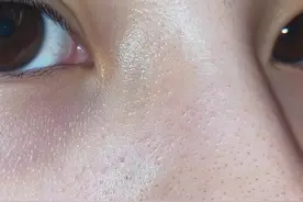 鼻子上的黑头怎么去除图片