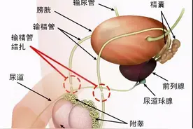 想去做输精管结扎，医院为什么不给做？图片