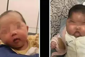 因用护肤霜，3个月的婴儿额头长满浓密汗毛，体重猛增但身高不长图片