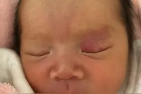 新生儿眼皮上有一片红色的图片