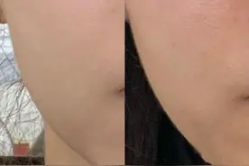 一篇说透男士毛孔粗大问题图片