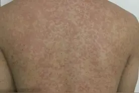 HIV抗病毒药物依非韦伦的常见副作用及应对方法图片