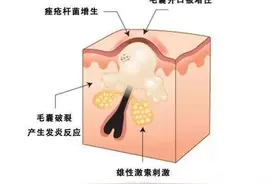 痘痘如何形成的？图片