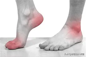 医生说治疗痛风有三条路：给炎症绝路，给尿酸出路，给肾脏活路图片