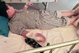 捡来的二踢脚点着玩，鞍山９岁男孩子被崩得指掌分离图片