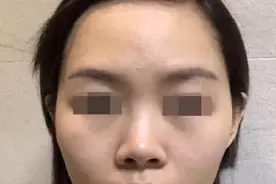韦敏精讲丨鼻孔暴露过多不美观，应该如何改善图片