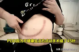 PDD自爆一件坏事，再不重视健康人就没了，然后又抽了一口电子烟图片