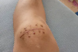 髌骨骨折恢复中图片
