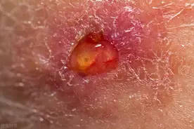 老人手背长了肿物，自行用鸡眼膏外敷，组织腐烂，最后不幸发生图片