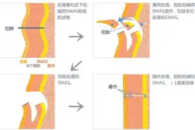 面部手术除皱效果咋样？小切口面部提升手术效果杠杠的图片
