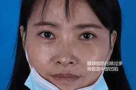 做完眼袋手术，后悔了！做女人不能对自己太狠图片