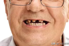 烂牙残根到底要不要拔？不拔危害到底有多大？牙科专家给出答案图片