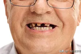 烂牙残根到底要不要拔？不拔危害到底有多大？牙科专家给出答案图片