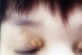 眼角长黄色肉疙瘩，是怎么回事？医生提醒：可能血脂有异常！图片