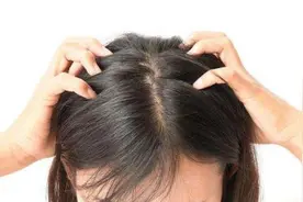 头发出油，头皮奇痒？教你简单方法解决！一个月养好头皮图片