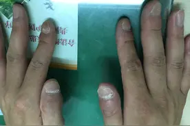 反复关节肿痛，原来竟是银屑病的“孪生兄弟”——银屑病关节炎图片