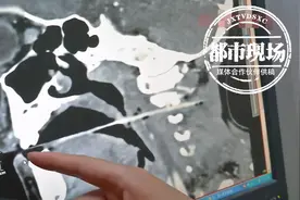 揪心！6岁男孩吃烤肠时不慎摔倒，15厘米竹签直戳咽喉图片