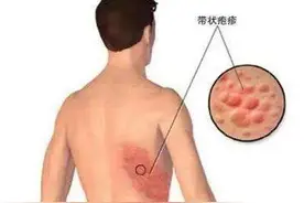 重磅！带状疱疹疫苗终于来了，7月开打图片