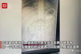 “春天我种了个手机在肚子里，秋天就收获了许多手机...”男子吞下手机4天才去取出 医生惊呼：最奇怪手术图片