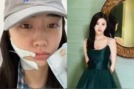 景甜拔牙后右脸发肿，素颜照和精修图判若两人，网友直呼认不出图片