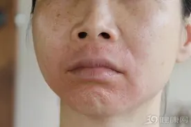 湿疹、体癣、缠腰蛇，擦什么好得快？常见皮肤病“用药指南”来了图片