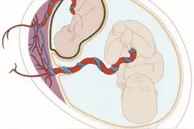 双胎之一有缺陷，不能同时降生？杭妇院宫内治疗为妈妈留下健康宝宝图片