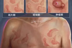吓死！深圳5岁女孩长白斑，以为有蛔虫，3年后发现是肿瘤图片