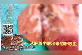 幼儿吃三文鱼结果出问题，去体检竟查出肝吸虫，家属不敢相信视频封面